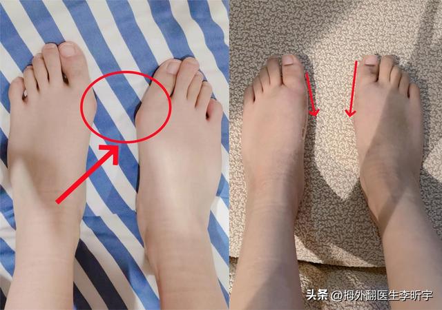 太痛苦!30岁年轻美女拇外翻,纤细的脚面越来越宽,36码鞋变45码