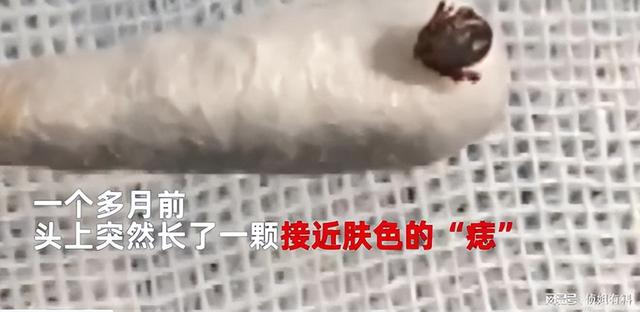 湖南9岁女孩被蜱虫钻进头皮吸血1个月 网友:看着都疼