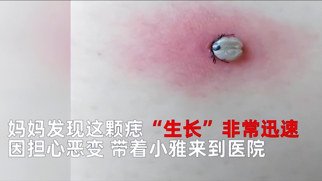 湖南9岁女孩被蜱虫钻进头皮吸血1个月 网友:看着都疼