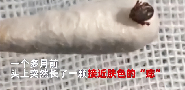 湖南9岁女孩被蜱虫钻进头皮吸血1个月 网友:看着都疼