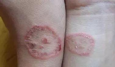 俩美女合租一间房得了一样的病:手腕上都长了“表”……