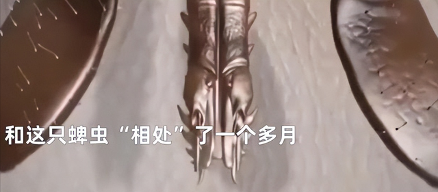 湖南9岁女孩被蜱虫钻进头皮吸血1个月 网友:看着都疼