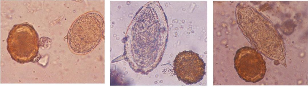 男子湖里游泳后出现血尿症状,竟是这种虫子“作祟”!预防方法→