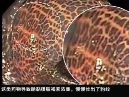 这种息肉可能会变成癌！排便出现这4种异常建议及时就医