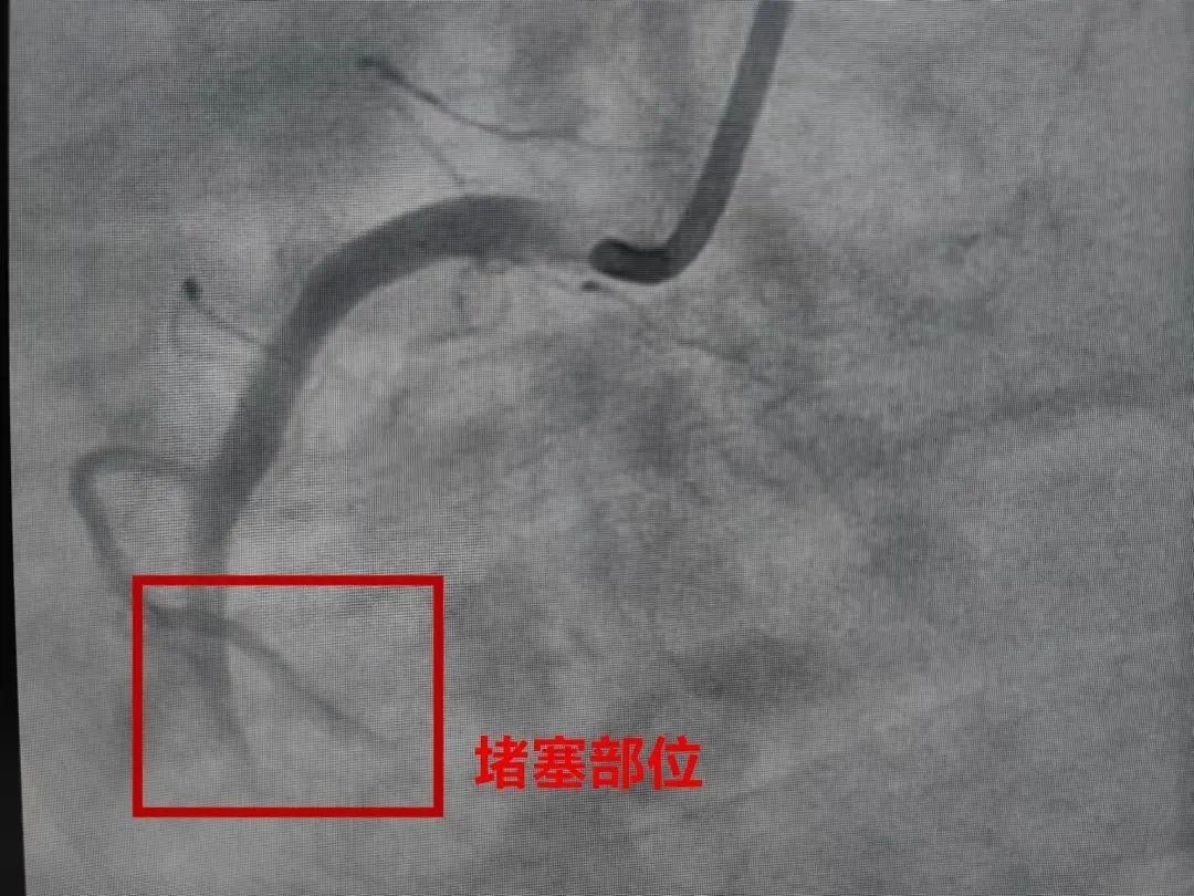突发心梗趋于年轻化 急救指南一定要看→